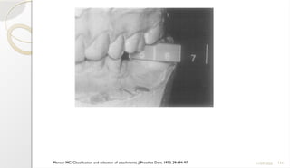134
11/09/2025
Mensor MC. Classification and selection of attachments. J Prosthet Dent. 1973; 29:494-97
 