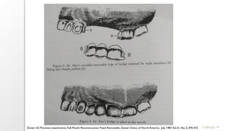 19
11/09/2025
Zinner I.D. Precision attachments, Full-Mouth Reconstruction: Fixed Removable, Dental Clinics of North America, July 1987,Vol.31, No. 3, 395-415
 