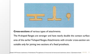 25
11/09/2025
Preiskel H.W. Precision attachments in Prosthodontics:The applications of intracoronal and extracoronal attachments, volume 1, Quintessence books
Cross-sections of various types of attachments.
The H-shaped flanges are stronger and have nearly double the contact surface
area of the earlier T-shaped flanges.Attachments with circular cross-section are
suitable only for joining two sections of a fixed prosthesis.
 
