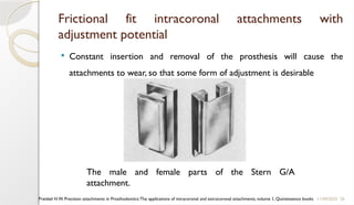 26
Frictional fit intracoronal attachments with
adjustment potential
 Constant insertion and removal of the prosthesis will cause the
attachments to wear, so that some form of adjustment is desirable
11/09/2025
Preiskel H.W. Precision attachments in Prosthodontics:The applications of intracoronal and extracoronal attachments, volume 1, Quintessence books
The male and female parts of the Stern G/A
attachment.
 