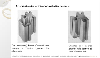 27
Crismani series of intracoronal attachments
11/09/2025
Preiskel H.W. Precision attachments in Prosthodontics:The applications of intracoronal and extracoronal attachments, volume 1, Quintessence books
The narrower(2.8mm) Crismani unit
features a central groove for
adjustment
Chamfer and tapered
gingival male section to
facilitate insertion
 