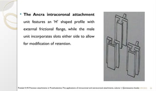 30
 The Ancra intracoronal attachment
unit features an ‘H’ shaped profile with
external frictional flange, while the male
unit incorporates slots either side to allow
for modification of retention.
11/09/2025
Preiskel H.W. Precision attachments in Prosthodontics:The applications of intracoronal and extracoronal attachments, volume 1, Quintessence books
 