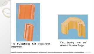 31
11/09/2025
The T
-Geschiebe 123 intracoronal
attachment
Cast bracing arm and
external frictional flange
Preiskel H.W. Precision attachments in Prosthodontics:The applications of intracoronal and extracoronal attachments, volume 1, Quintessence books
 