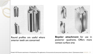 39
11/09/2025
Round profiles are useful where
anterior teeth are concerned
Beyeler attachment for use in
posterior quadrants. Offers more
contact surface area
Preiskel H.W. Precision attachments in Prosthodontics:The applications of intracoronal and extracoronal attachments, volume 1, Quintessence books
 
