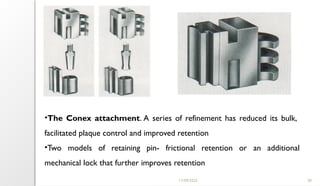 11/09/2025 58
•The Conex attachment. A series of refinement has reduced its bulk,
facilitated plaque control and improved retention
•Two models of retaining pin- frictional retention or an additional
mechanical lock that further improves retention
 