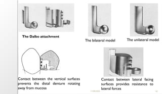 11/09/2025 62
The Dalbo attachment
The bilateral model The unilateral model
Contact between the vertical surfaces
prevents the distal denture rotating
away from mucosa
Contact between lateral facing
surfaces provides resistance to
lateral forces
 