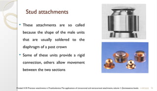 79
Stud attachments
 These attachments are so called
because the shape of the male units
that are usually soldered to the
diaphragm of a post crown
 Some of these units provide a rigid
connection, others allow movement
between the two sections
11/09/2025
Preiskel H.W. Precision attachments in Prosthodontics:The applications of intracoronal and extracoronal attachments, volume 1, Quintessence books
 