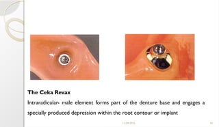 11/09/2025 81
The Ceka Revax
Intraradicular- male element forms part of the denture base and engages a
specially produced depression within the root contour or implant
 