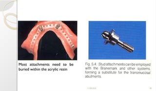 11/09/2025 85
Most attachments need to be
buried within the acrylic resin
 