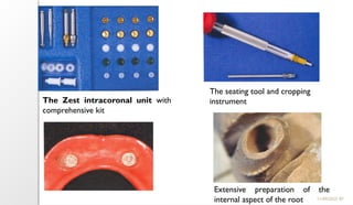 87
11/09/2025
The Zest intracoronal unit with
comprehensive kit
The seating tool and cropping
instrument
Extensive preparation of the
internal aspect of the root
 