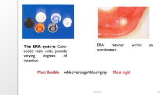 11/09/2025 88
The ERA system. Color
coded resin units provide
varying degrees of
retention
ERA retainer within an
overdenture
Most flexible white>orange>blue>gray Most rigid
 