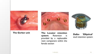 11/09/2025 90
The Gerber unit The Locator retention
system. Retention is
provided by a replaceable
resin component within the
female section
Dalbo ‘Elliptical’
stud retention system
 
