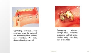 11/09/2025 94
Connecting adjacent
copings resist rotational
forces and inclined forces
resolve along the long
axes of the roots
Conflicting undercuts- base
extension must be reduced,
this will compromise stiffness
and retention. A metal
denture base is preferred
 