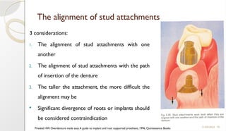 95
The alignment of stud attachments
3 considerations:
1. The alignment of stud attachments with one
another
2. The alignment of stud attachments with the path
of insertion of the denture
3. The taller the attachment, the more difficult the
alignment may be
 Significant divergence of roots or implants should
be considered contraindication
11/09/2025
Prieskel HW. Overdenture made easy A guide to implant and root supported prosthesis, 1996, Quintessence Books
 
