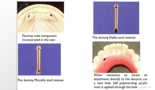 97
11/09/2025
Dummy male component
incorporated in the cast
The dummy Dalbo stud retainer
The dummy Microfix stud retainer
When necessary to locate an
attachment directly to the denture, cut
a vent hole. Self polymerizing acrylic
resin is applied through the hole
 