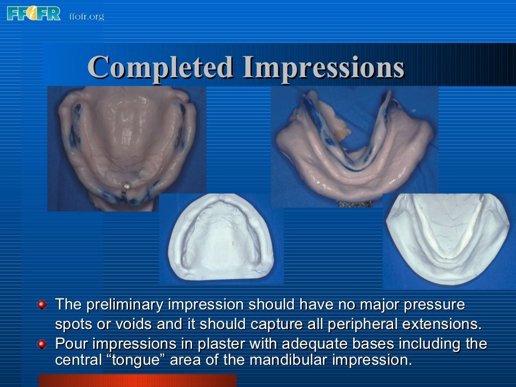 What Are Preliminary Impressions Used To Make 5.preliminary impressions