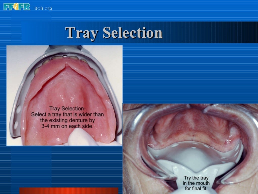 5.preliminary impressions