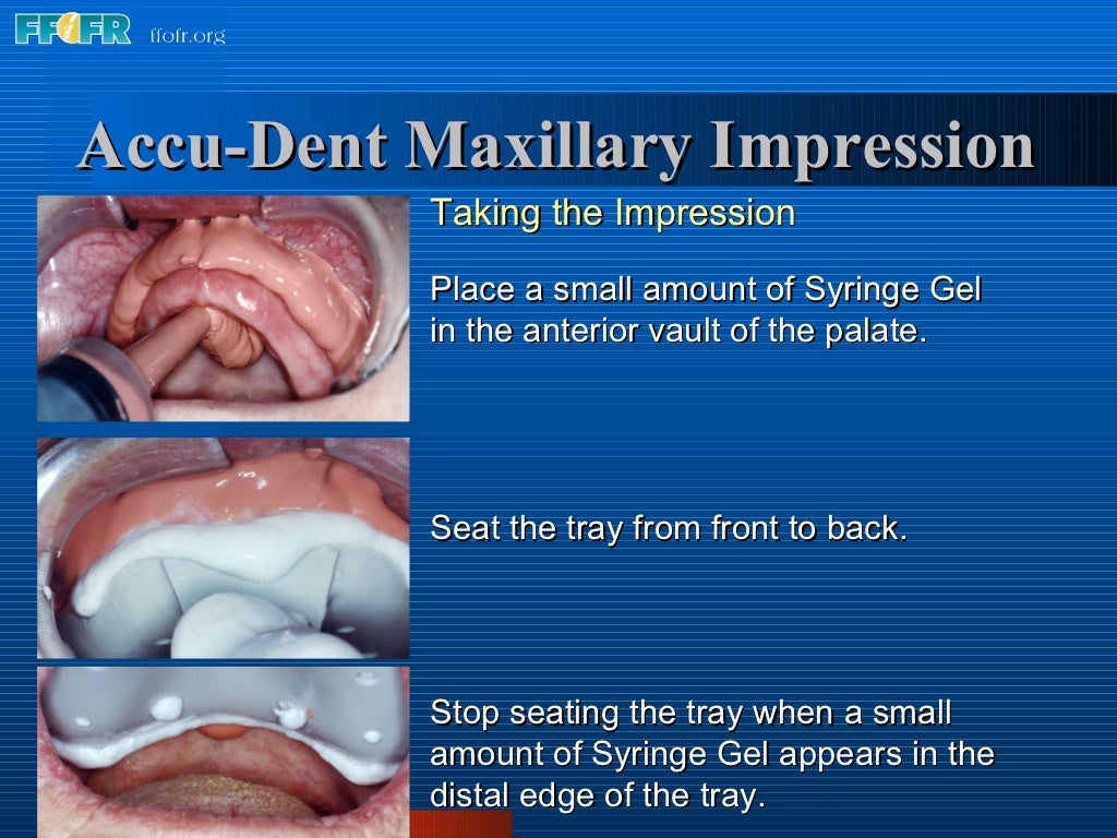 5.preliminary impressions