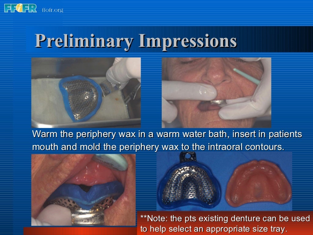 What Are Preliminary Impressions Used To Make 5.preliminary impressions