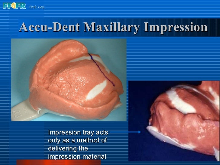 What Are Preliminary Impressions Used To Make 5.preliminary impressions