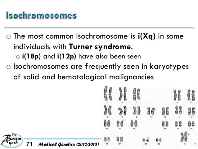 Isochromosome Xq