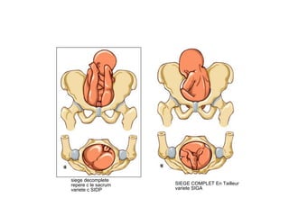 SIEGE COMPLET En Tailleur
variete SIGA
siege decomplete
repere c le sacrum
variete c SIDP
 