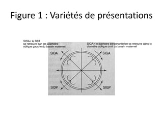 Figure 1 : Variétés de présentations
SIGA= le diametre bitrochanterien se retrouve dans le
diametre oblique droit du bassin maternel
SIDA= le DBT
se retrouve dan les Diametre
oblique gauche du bassin maternel
 
