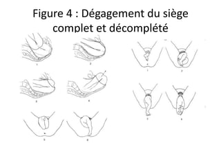 Figure 4 : Dégagement du siège
complet et décomplété
 