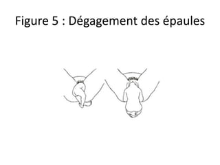 Figure 5 : Dégagement des épaules
 