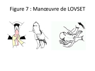 Figure 7 : Manœuvre de LOVSET
 
