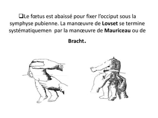 ❑Le fœtus est abaissé pour fixer l’occiput sous la
symphyse pubienne. La manœuvre de Lovset se termine
systématiquemen par la manœuvre de Mauriceau ou de
Bracht.
 