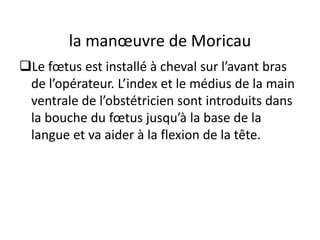 la manœuvre de Moricau
❑Le fœtus est installé à cheval sur l’avant bras
de l’opérateur. L’index et le médius de la main
ventrale de l’obstétricien sont introduits dans
la bouche du fœtus jusqu’à la base de la
langue et va aider à la flexion de la tête.
 