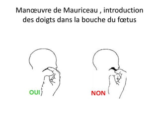 Manœuvre de Mauriceau , introduction
des doigts dans la bouche du fœtus
 