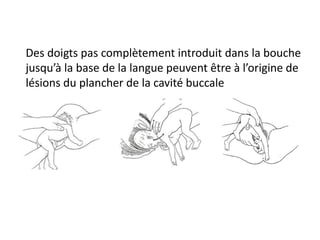 Des doigts pas complètement introduit dans la bouche
jusqu’à la base de la langue peuvent être à l’origine de
lésions du plancher de la cavité buccale
 