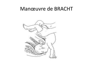 Manœuvre de BRACHT
 