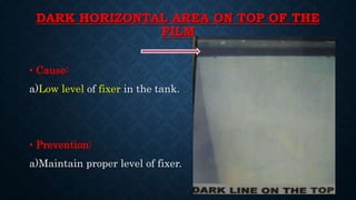 DARK HORIZONTAL AREA ON TOP OF THE
FILM
• Cause:
a)Low level of fixer in the tank.
• Prevention:
a)Maintain proper level of fixer.
 