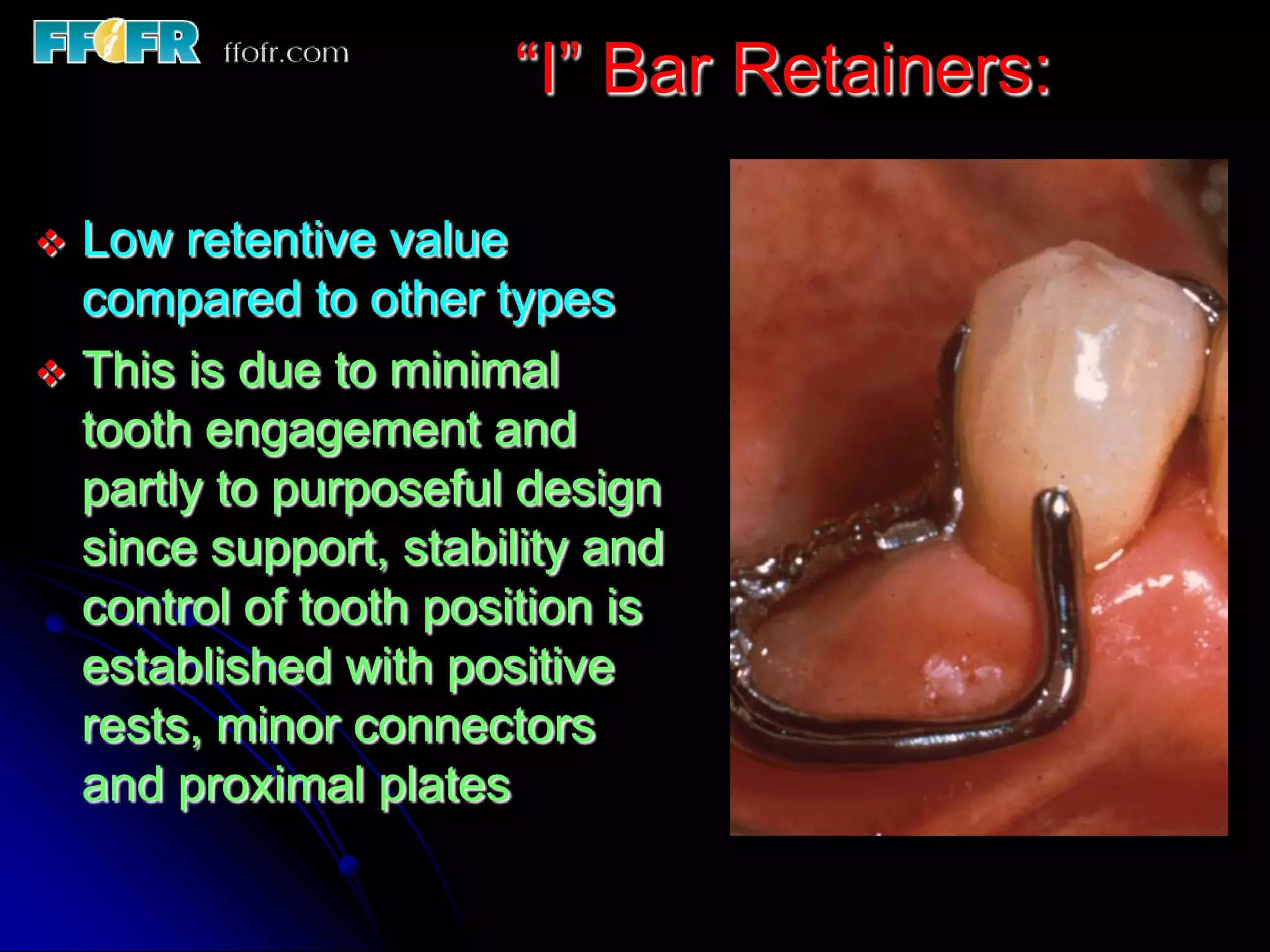 5.retainers, clasp assemblies and indirect retainers | PPT