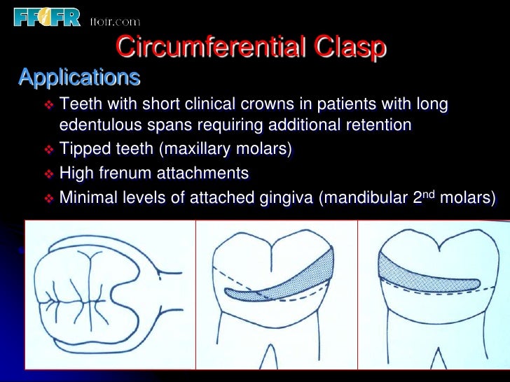 5.retainers, clasp assemblies and indirect retainers
