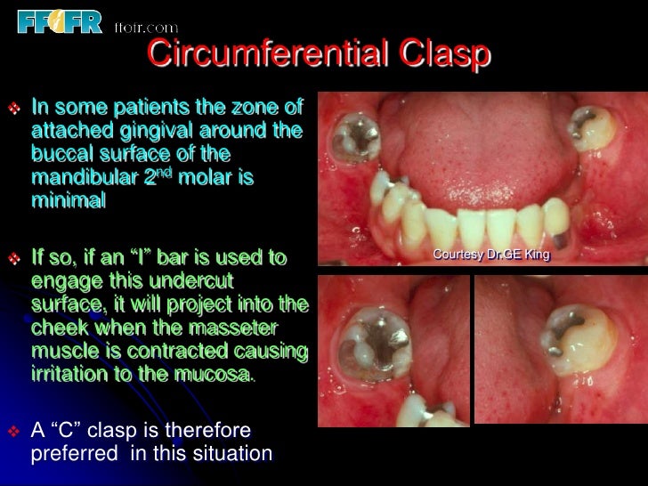 5.retainers, clasp assemblies and indirect retainers
