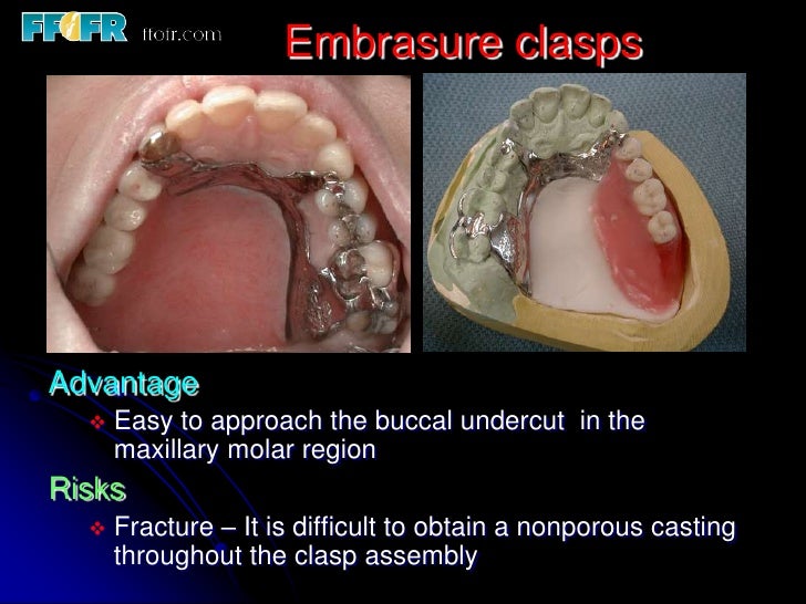 5.retainers, clasp assemblies and indirect retainers
