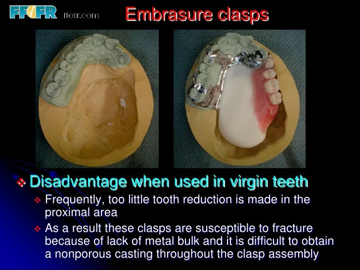 5.retainers, clasp assemblies and indirect retainers