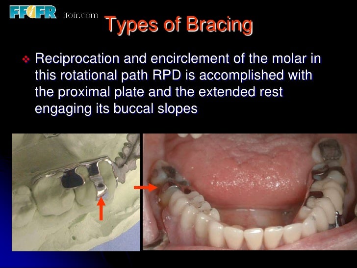 5.retainers, clasp assemblies and indirect retainers