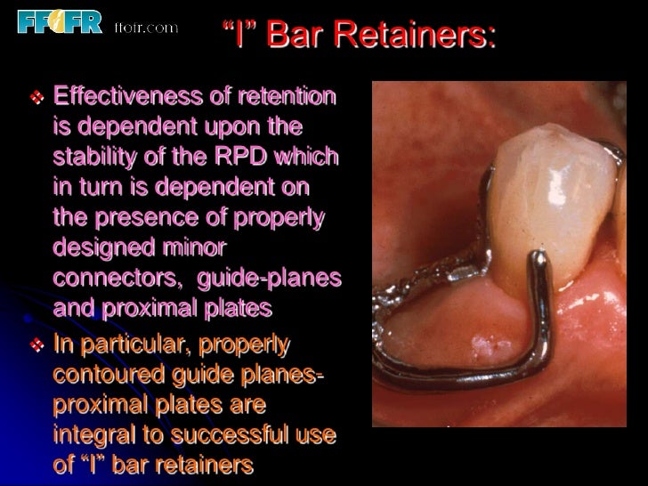 5 retainers clasp assemblies and indirect retainers bar clasp design