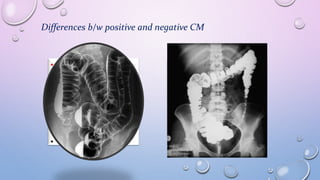 Differences b/w positive and negative CM
• Negative contrast
• AIR OR CO2
• Radiolucent
• Low atomic #
material
• Black on film
• Positive contrast
• all others
• Radiopaque
• High atomic # material
• White on film
 