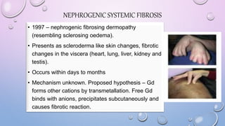 NEPHROGENIC SYSTEMIC FIBROSIS
• 1997 – nephrogenic fibrosing dermopathy
(resembling sclerosing oedema).
• Presents as scleroderma like skin changes, fibrotic
changes in the viscera (heart, lung, liver, kidney and
testis).
• Occurs within days to months
• Mechanism unknown. Proposed hypothesis – Gd
forms other cations by transmetallation. Free Gd
binds with anions, precipitates subcutaneously and
causes fibrotic reaction.
 