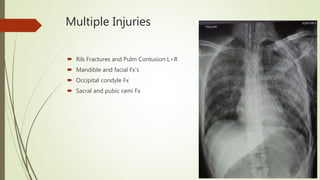 Multiple Injuries
 Rib Fractures and Pulm Contusion L>R
 Mandible and facial Fx’s
 Occipital condyle Fx
 Sacral and pubic rami Fx
 