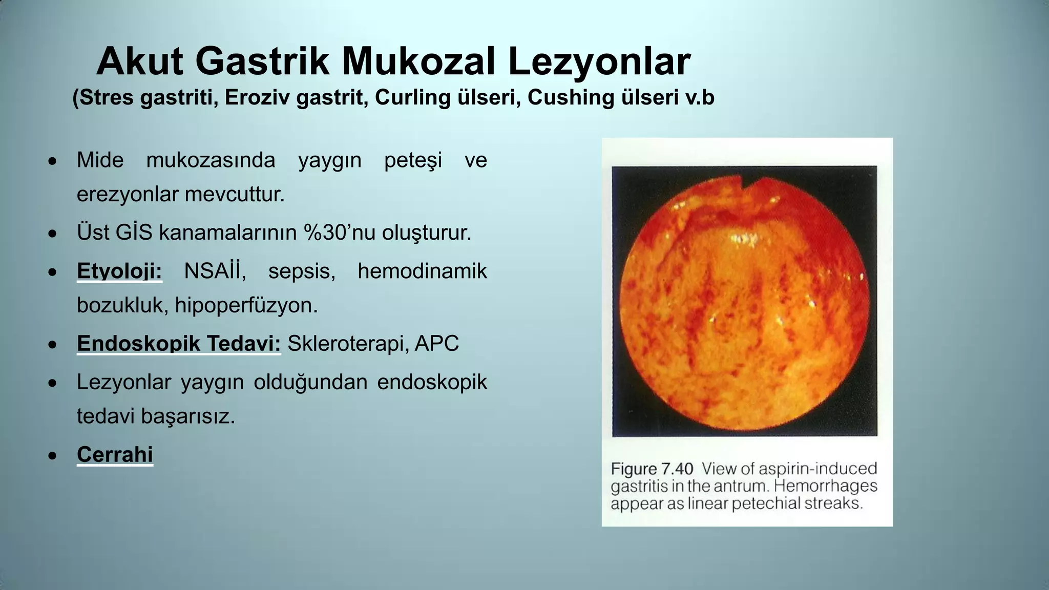 Akut Gastrik Mukozal Lezyonlar
(Stres gastriti, Eroziv gastrit, Curling ülseri, Cushing ülseri v.b
 Mide mukozasında yaygın peteşi ve
erezyonlar mevcuttur.
 Üst GİS kanamalarının %30’nu oluşturur.
 Etyoloji: NSAİİ, sepsis, hemodinamik
bozukluk, hipoperfüzyon.
 Endoskopik Tedavi: Skleroterapi, APC
 Lezyonlar yaygın olduğundan endoskopik
tedavi başarısız.
 Cerrahi
 