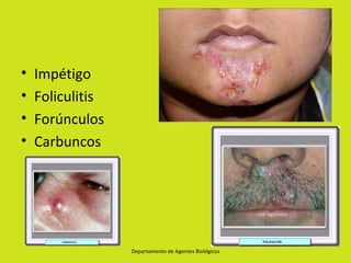 •   Impétigo
•   Foliculitis
•   Forúnculos
•   Carbuncos




                  Departamento de Agentes Biológicos
 
