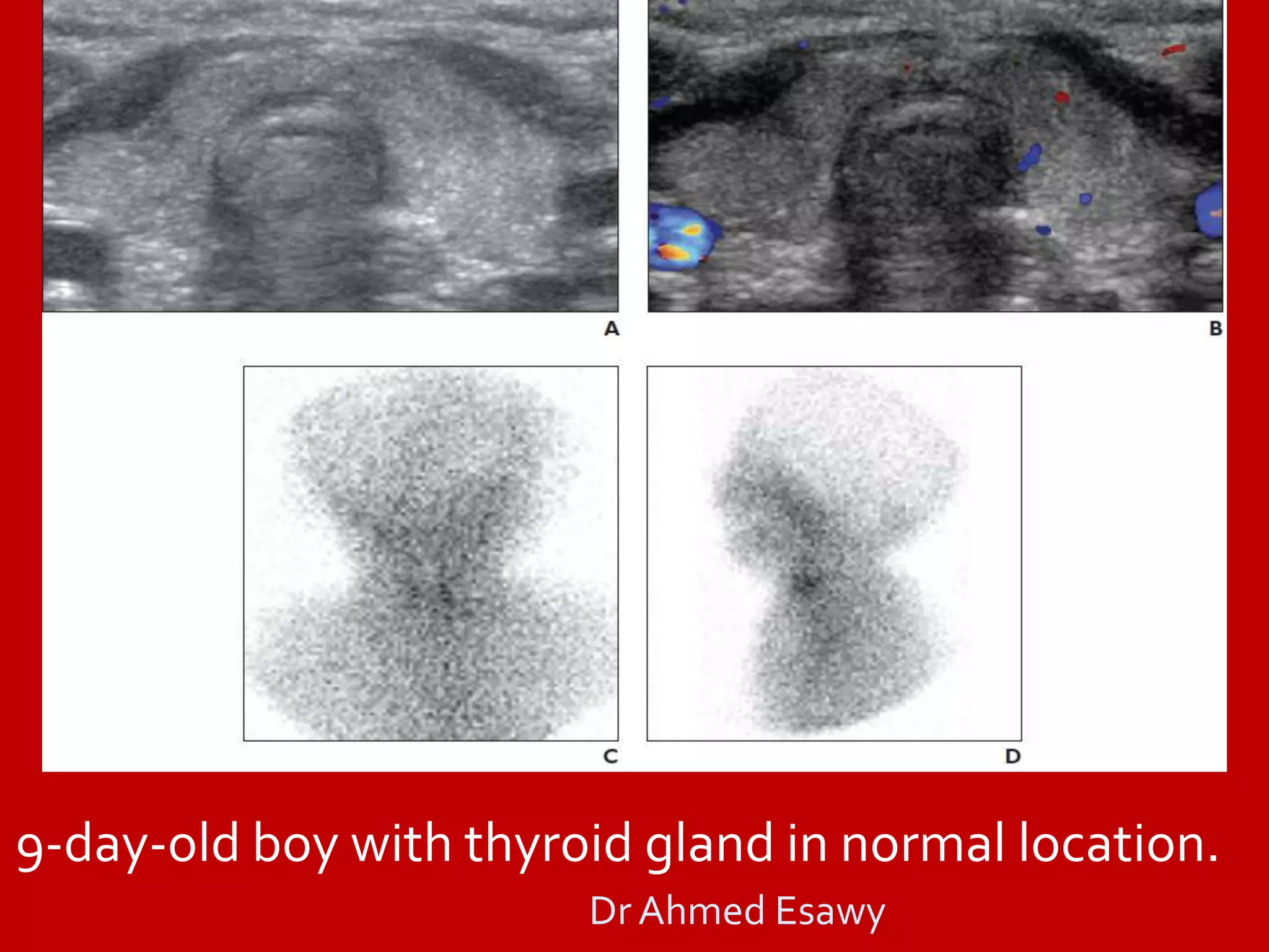 thyriod gland imaging part 5 (molecular imaging nuclear imaging spect ...