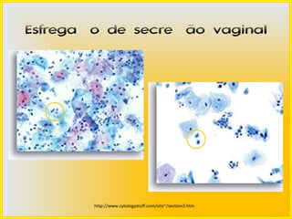 Esfregaço de secreção vaginal




        http://www.cytologystuff.com/site~/section3.htm
 